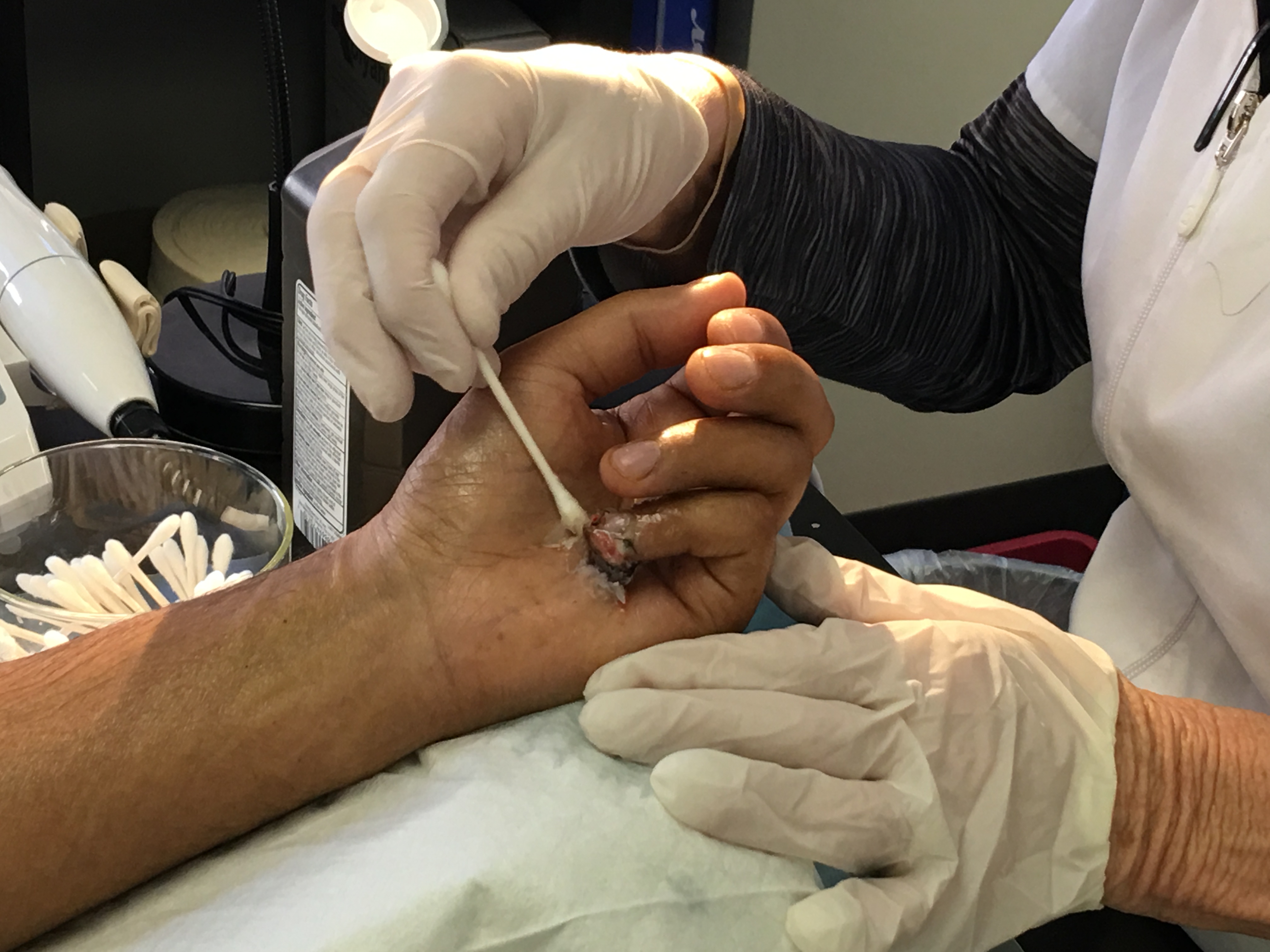 Therapy - Hand